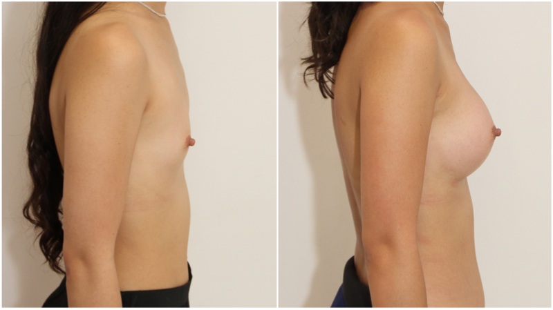 AA cup, minimal breast to start with, shape created with 255g anatomicals, dual-plane placed.
