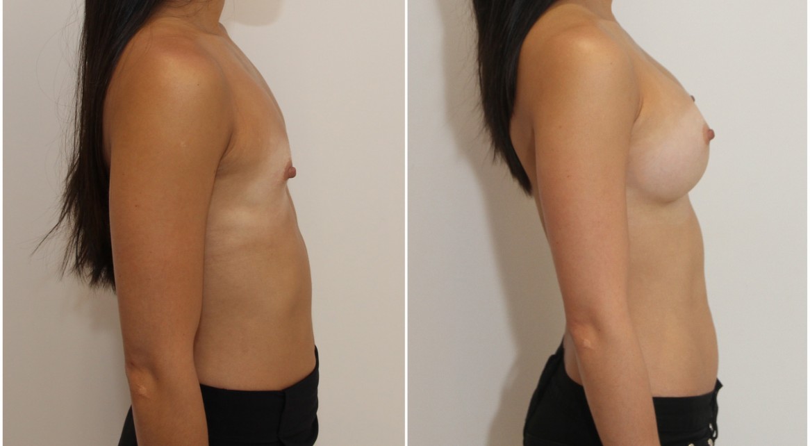 AA cup, virtually no breast tissue to start with. Augmentation with 305g extra high profile, P-URE style implants, maximum muscular coverage.