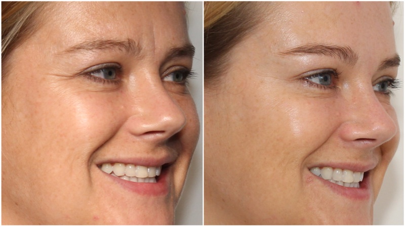 Anti-wrinkle injections used to soften frown, forehead and crowfeet, brow lift also achieved using anti-wrinkle injections. Hydrating filler used to soften under eye hollows
