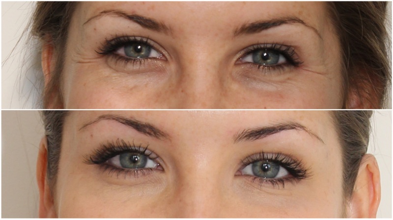 Crows feet softened and brow lift achieved using anti-wrinkle injections