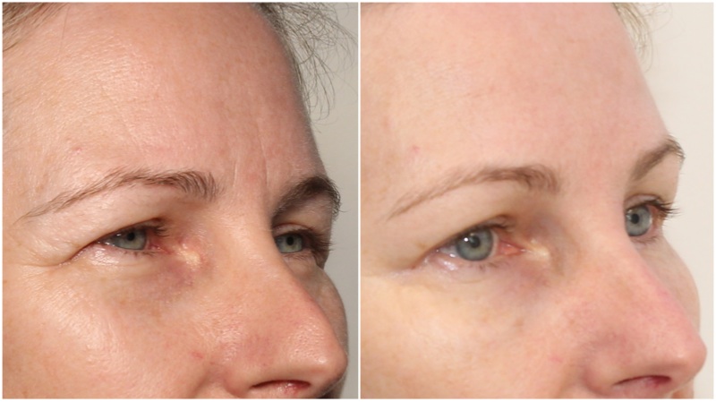 Brow lift achieved by treating the crows-feet and frown lines with anti-wrinkle injections