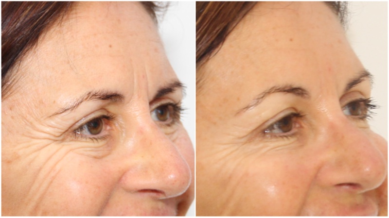 Softening frown, forehead and crows feet lines using anti-wrinkle injections