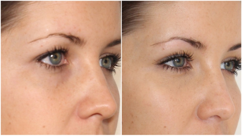 Softening under eye hollows using hydrating dermal filler in combination with anti-wrinkle injections