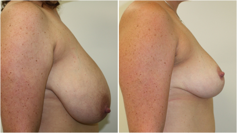 33yo female, children, vertical short-scar breast reduction and lift with nipple repositioning and reshaping. Approximately 650g of tissue removed from each breast, F cup -> C/D cup.