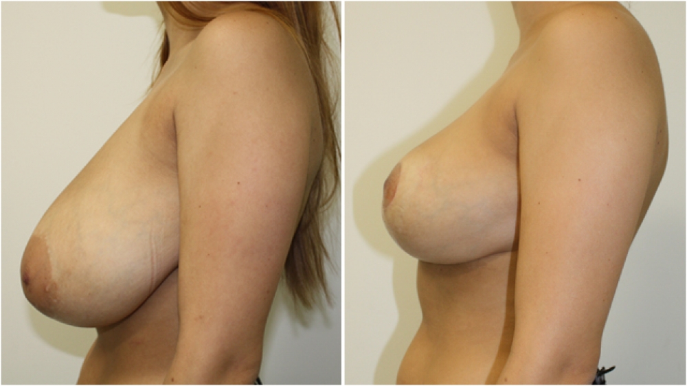 22yo female, vertical short-scar breast reduction and lift, nipple/areolar reshaping, approx 450g of breast tissue removed from each side, E/F cup -> D cup.