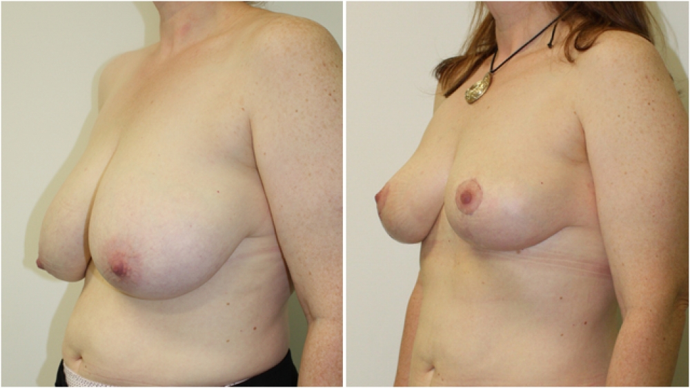 Late 40s, no children, vertical short-scar breast reduction and lift with nipple repositioning and reshaping. Approximately 250g tissue removed from each breast, DD -> C cup.