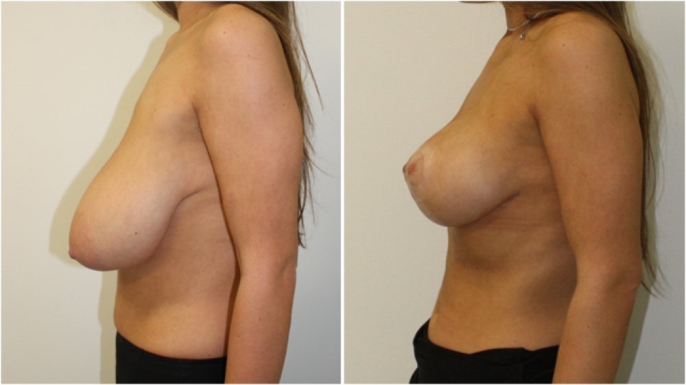 Early 20s, no children, vertical short-scar breast reduction and lift with nipple repositioning and reshaping, approximately 500g tissue removed from each breast, E -> D cup.