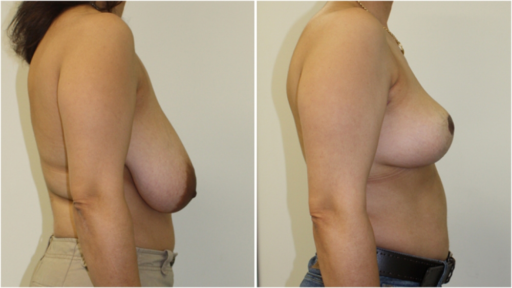 Early 40s, three children, vertical short scar breast reduction and lift with nipple/areolar reshaping.