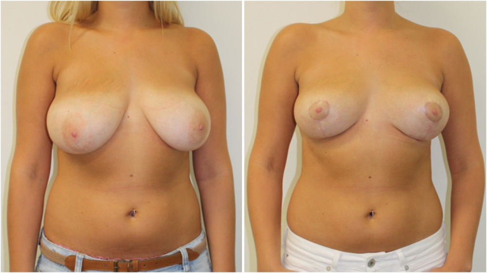 Late 20s, no children, vertical short-scar breast reduction and lift, nipple/areolar reshaping and repositioning, approx 200g breast tissue removed from each side.