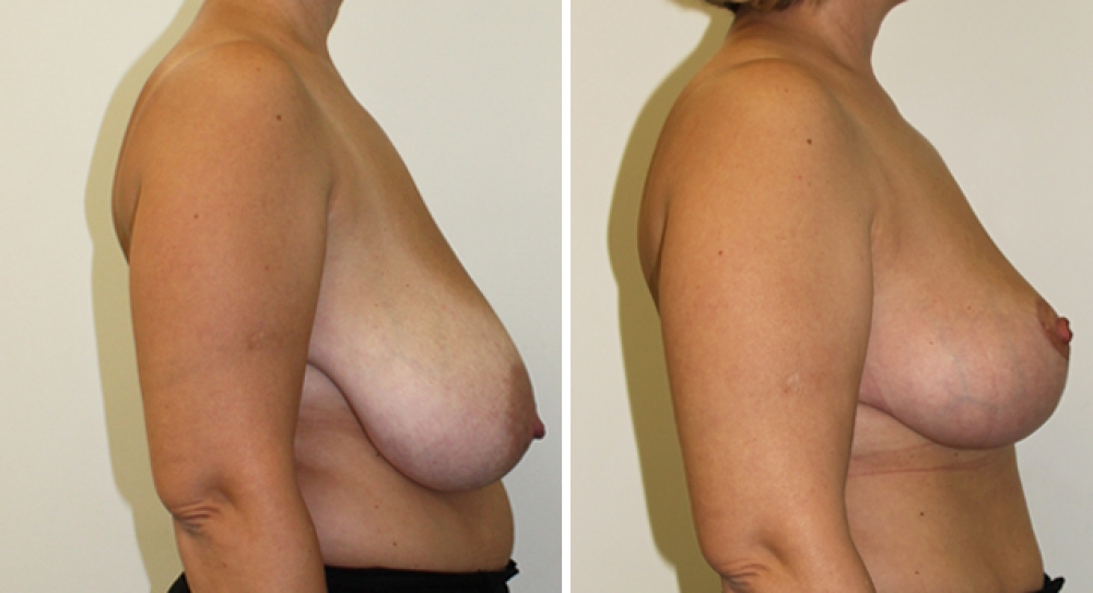 Mid 40's, 2 children, vertical short scar breast reduction/lift with nipple repositioning.