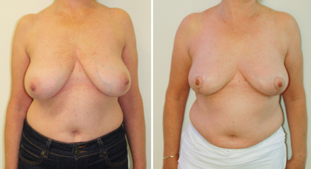 Early 50s, 2 children, vertical short scar reduction/lift with nipple repositioning, approx 200g of breast tissue removed from each side.