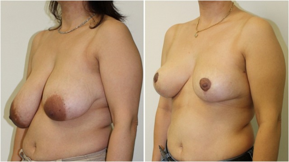Early 40s, three children, vertical short scar breast reduction and lift with nipple/areolar reshaping.