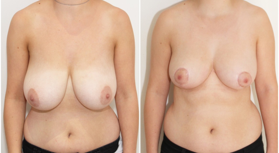 20s, breast reduction/lift/reshape with removal of 610g tissue right breast and 525g tissue left breast.