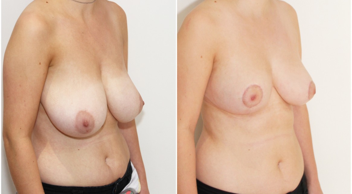 20s, breast reduction/lift/reshape with removal of 610g tissue right breast and 525g tissue left breast.