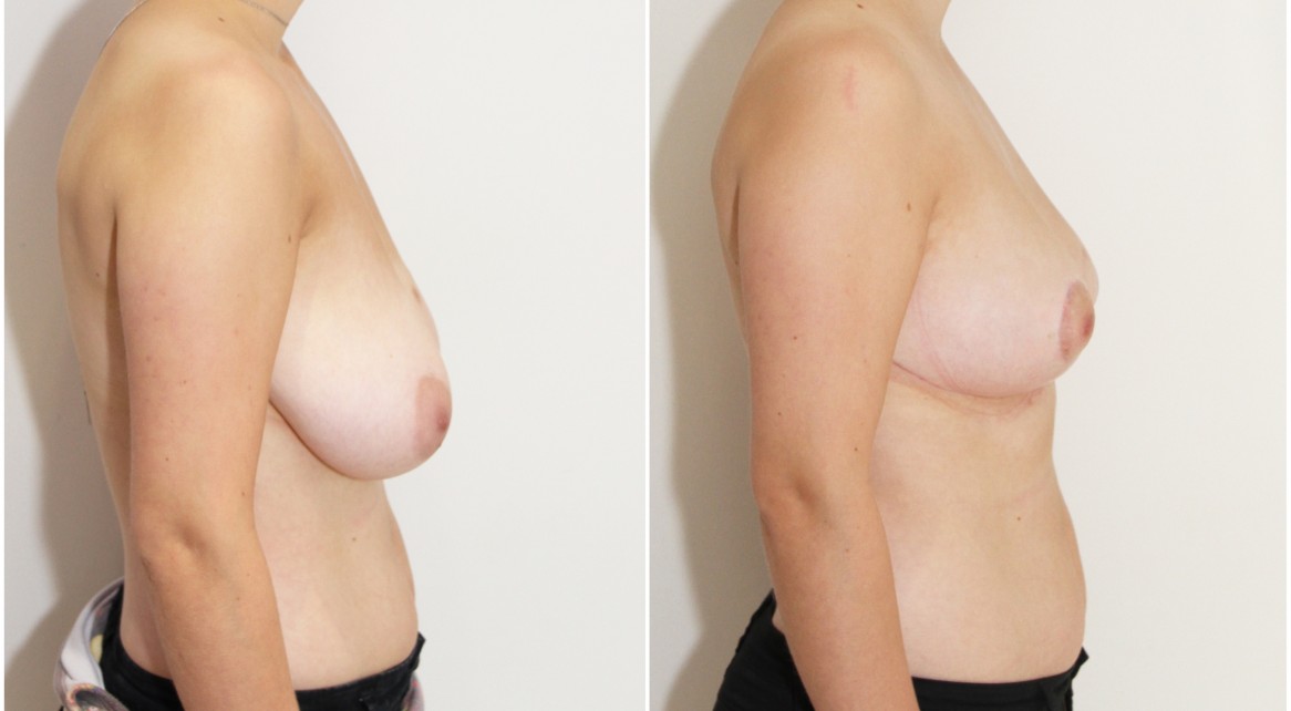 20s, breast reduction/lift/reshape with removal of 610g tissue right breast and 525g tissue left breast.